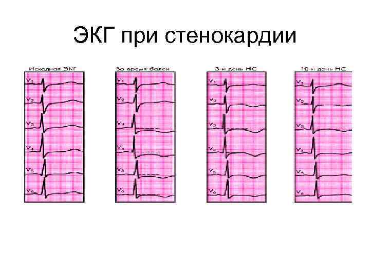 ЭКГ при стенокардии 