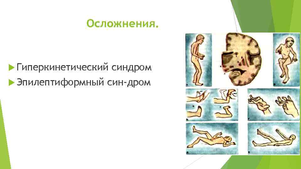 Осложнения. Гиперкинетический Эпилептиформный синдром син дром 