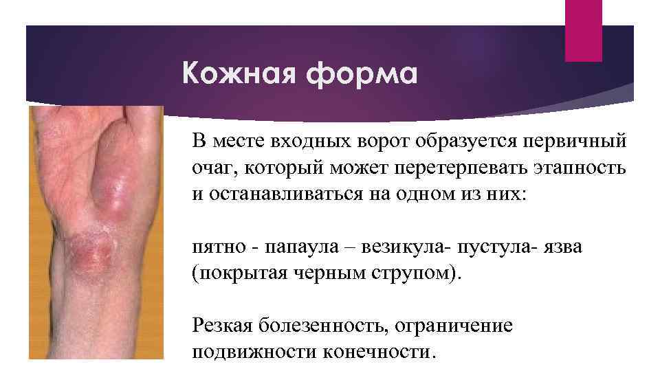 Кожная форма В месте входных ворот образуется первичный очаг, который может перетерпевать этапность и