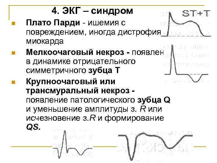 Ишемия на экг фото