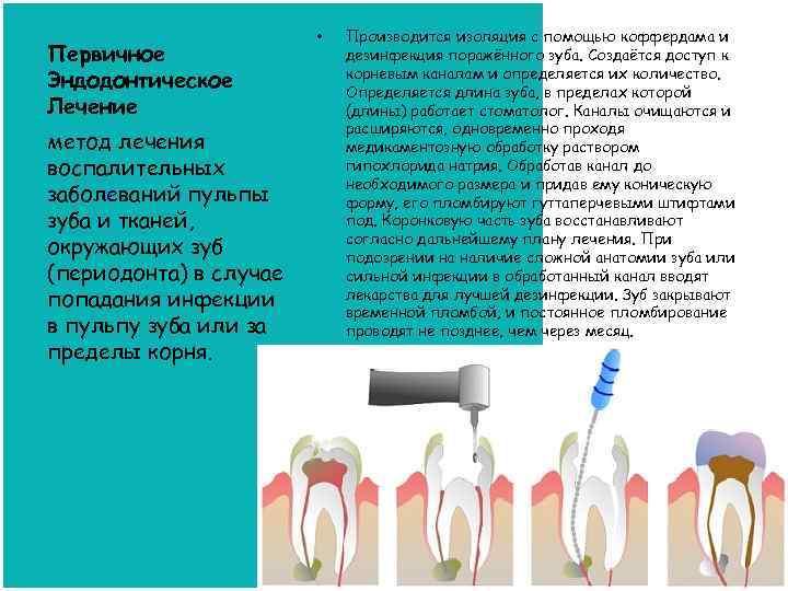 Первичное Эндодонтическое Лечение метод лечения воспалительных заболеваний пульпы зуба и тканей, окружающих зуб (периодонта)