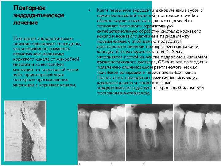 Повторное эндодонтическое лечение преследует те же цели, что и первичное, а именно: герметичною изоляцию