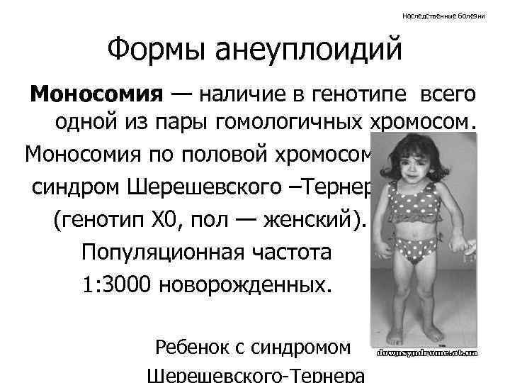 Наследственные болезни Формы анеуплоидий Моносомия — наличие в генотипе всего одной из пары гомологичных