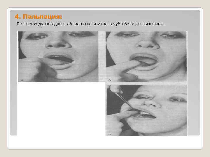 4. Пальпация: По переходу складке в области пульпитного зуба боли не вызывает. 
