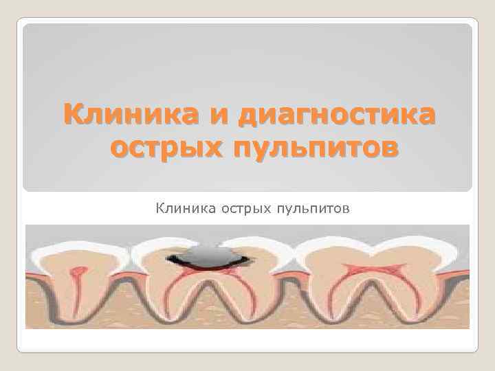 Клиника и диагностика острых пульпитов Клиника острых пульпитов 