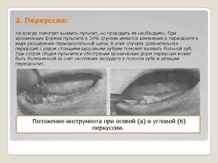 2. Перкуссия: Не всегда помогает выявить пульпит, но проводить ее необходимо. При хронических формах