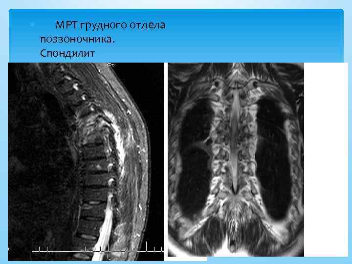  МРТ грудного отдела позвоночника. Спондилит 