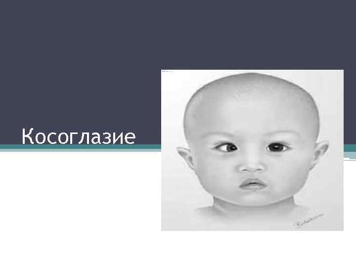 Косоглазие 