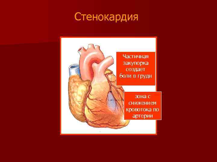 Стенокардия Частичная закупорка создает боли в груди зона с снижением кровотока по артерии 