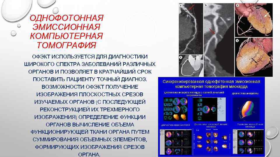 ОДНОФОТОННАЯ ЭМИССИОННАЯ КОМПЬЮТЕРНАЯ ТОМОГРАФИЯ ОФЭКТ ИСПОЛЬЗУЕТСЯ ДЛЯ ДИАГНОСТИКИ ШИРОКОГО СПЕКТРА ЗАБОЛЕВАНИЙ РАЗЛИЧНЫХ ОРГАНОВ И