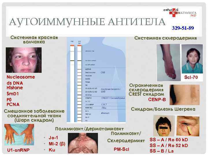 АУТОИММУННЫЕ АНТИТЕЛА Системная красная волчанка Nucleosome ds DNA Histone Sm. D 1 P 0