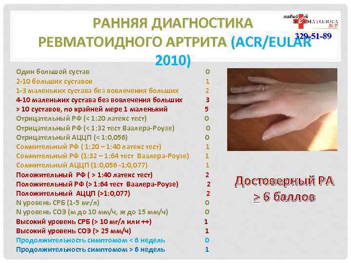 РАННЯЯ ДИАГНОСТИКА 329 -51 -89 РЕВМАТОИДНОГО АРТРИТА (ACR/EULAR 2010) Один большой сустав 2 -10