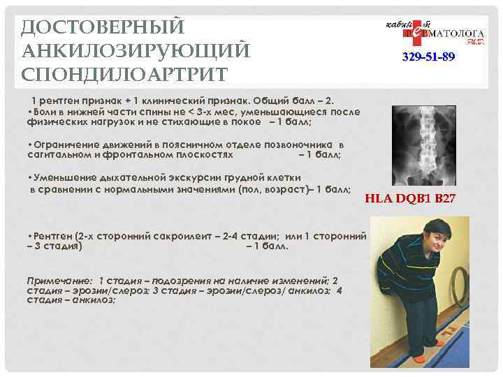 ДОСТОВЕРНЫЙ АНКИЛОЗИРУЮЩИЙ СПОНДИЛОАРТРИТ 329 -51 -89 1 рентген признак + 1 клинический признак. Общий
