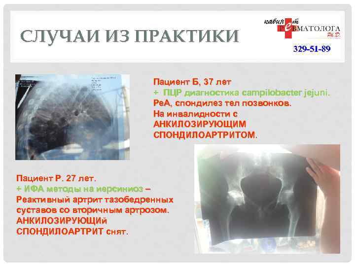 СЛУЧАИ ИЗ ПРАКТИКИ 329 -51 -89 Пациент Б, 37 лет + ПЦР диагностика campilobacter