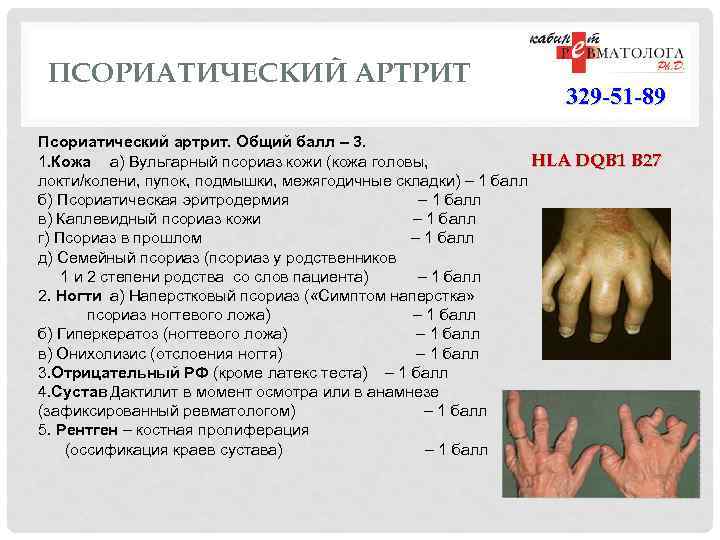 ПСОРИАТИЧЕСКИЙ АРТРИТ 329 -51 -89 Псориатический артрит. Общий балл – 3. HLA DQB 1