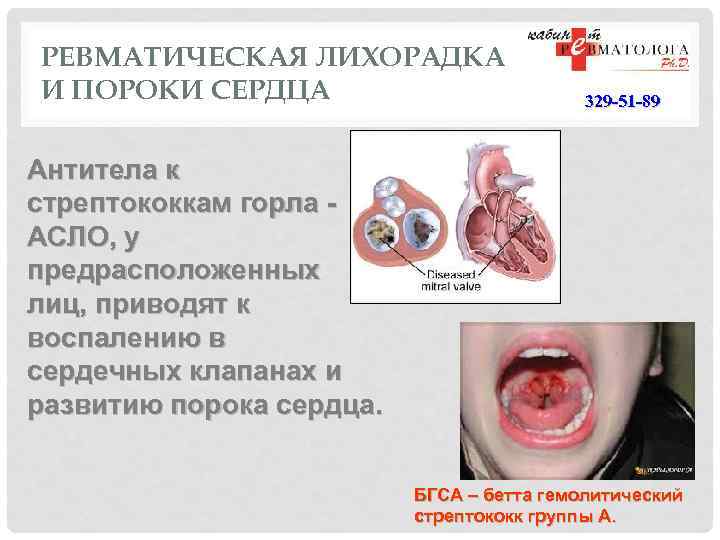 РЕВМАТИЧЕСКАЯ ЛИХОРАДКА И ПОРОКИ СЕРДЦА 329 -51 -89 Антитела к стрептококкам горла - АСЛО,