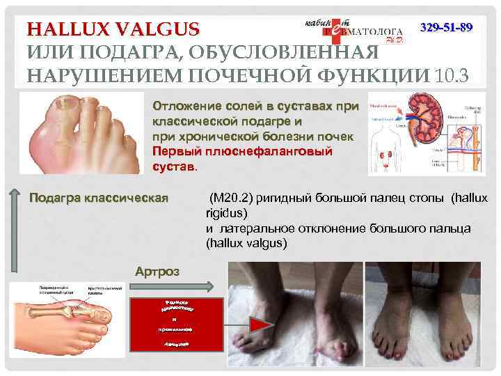 329 -51 -89 HALLUX VALGUS ИЛИ ПОДАГРА, ОБУСЛОВЛЕННАЯ НАРУШЕНИЕМ ПОЧЕЧНОЙ ФУНКЦИИ 10. 3 Отложение