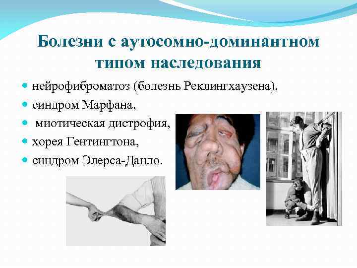 Болезни с аутосомно-доминантном типом наследования нейрофиброматоз (болезнь Реклингхаузена), синдром Марфана, миотическая дистрофия, хорея Гентингтона,