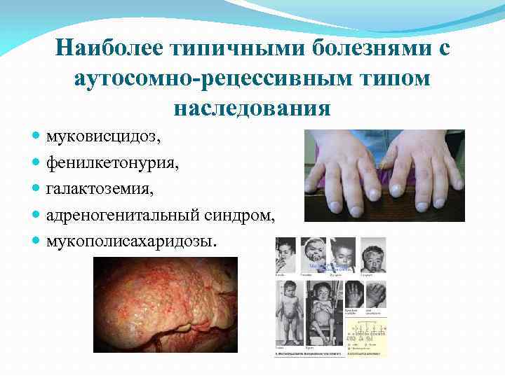 Наиболее типичными болезнями с аутосомно-рецессивным типом наследования муковисцидоз, фенилкетонурия, галактоземия, адреногенитальный синдром, мукополисахаридозы. 