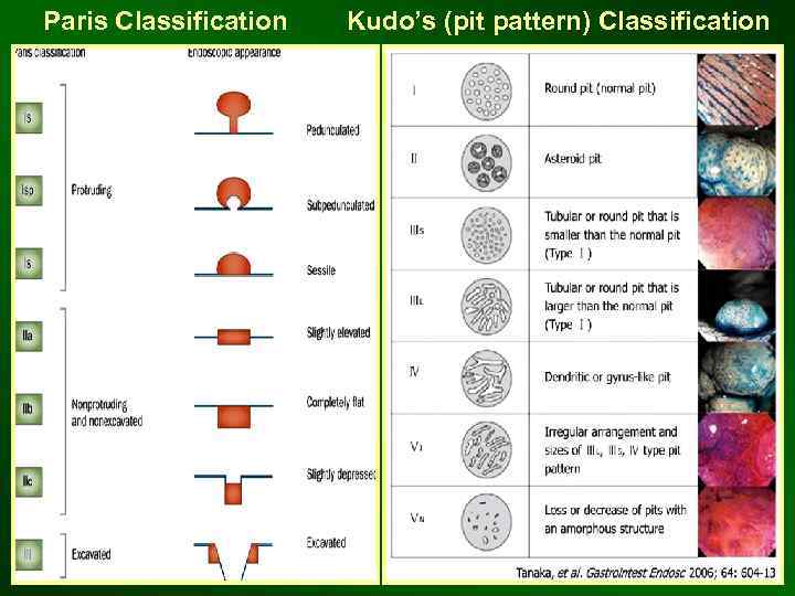 Paris Classification Kudo’s (pit pattern) Classification 