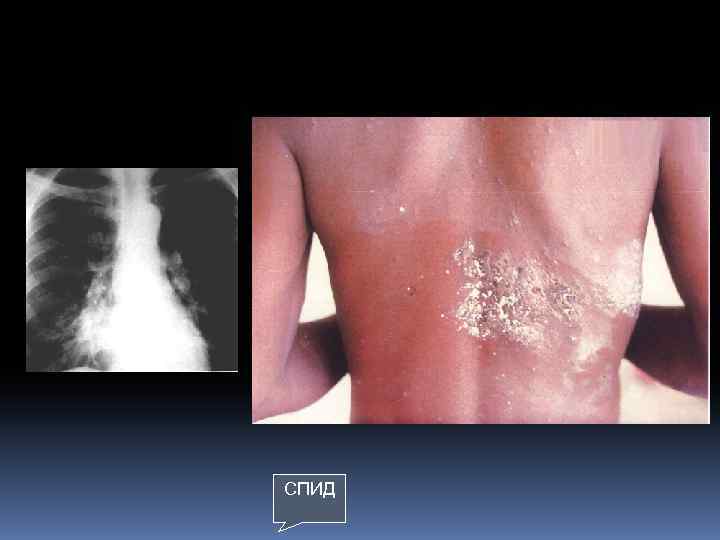 СПИД 