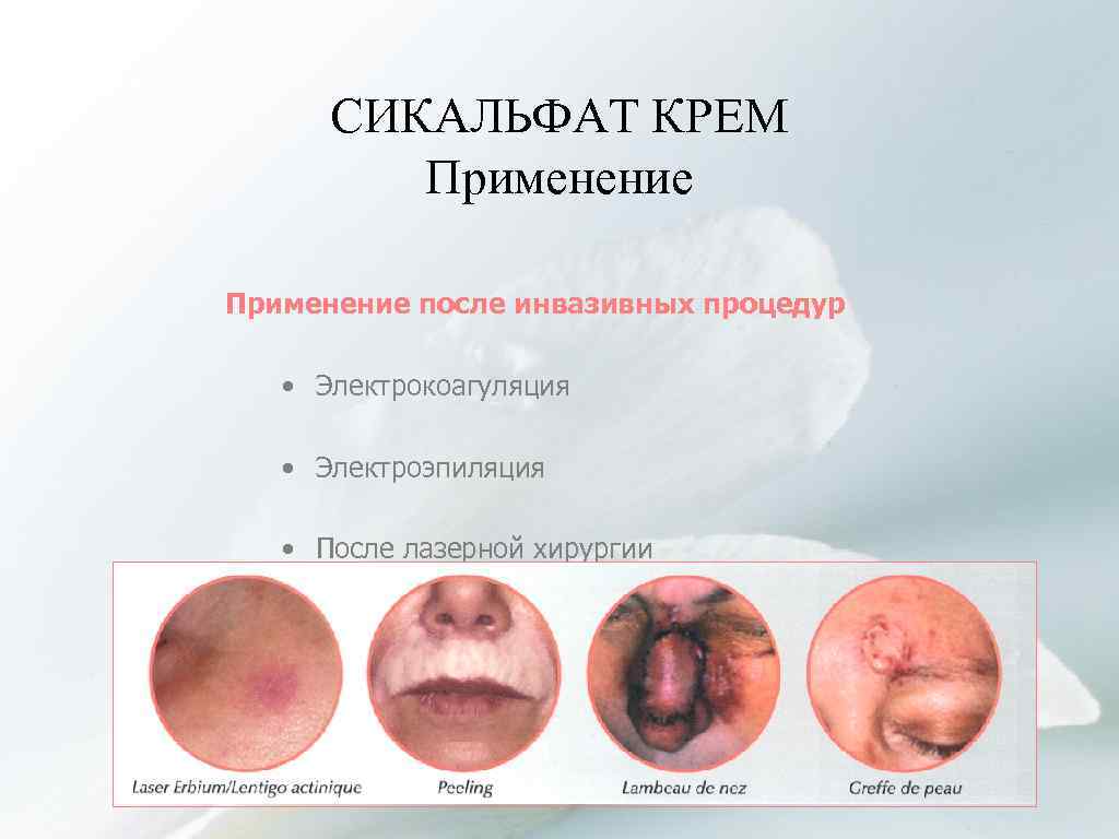 СИКАЛЬФАТ КРЕМ Применение после инвазивных процедур • Электрокоагуляция • Электроэпиляция • После лазерной хирургии