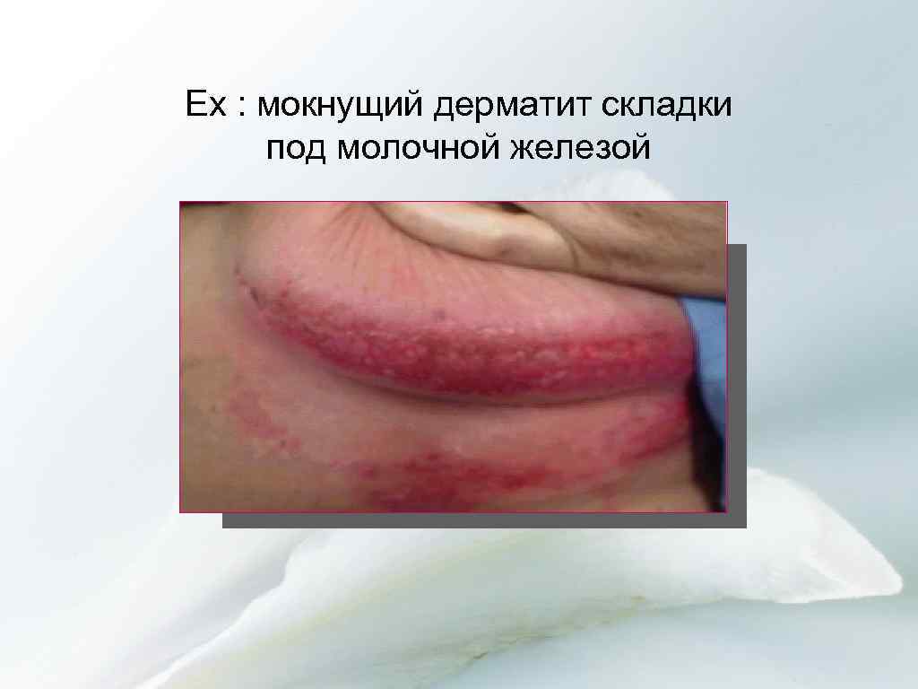 Ex : мокнущий дерматит складки под молочной железой 