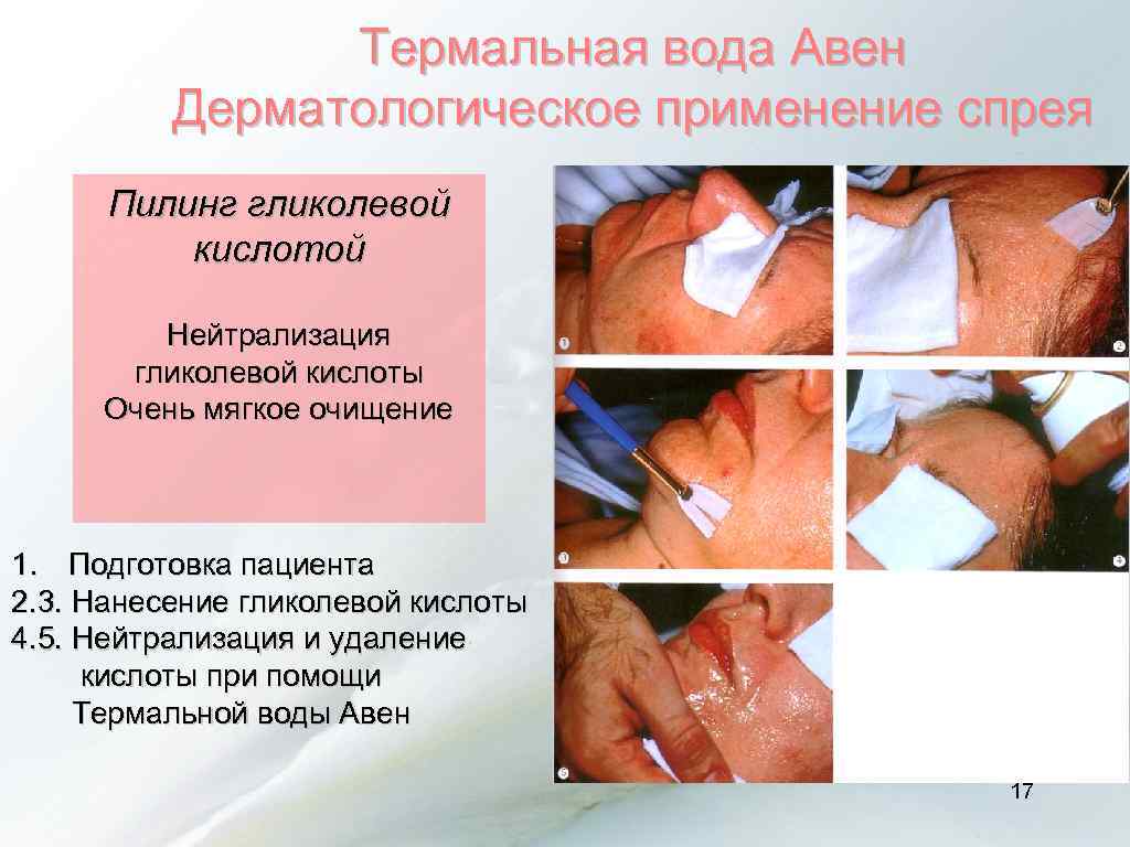 Термальная вода Авен Дерматологическое применение спрея Пилинг гликолевой кислотой Нейтрализация гликолевой кислоты Очень мягкое