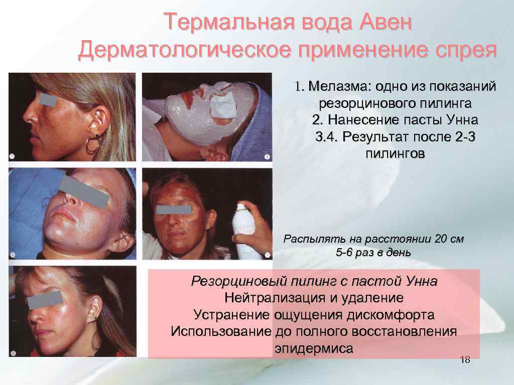 Термальная вода Авен Дерматологическое применение спрея 1. Мелазма: одно из показаний резорцинового пилинга 2.