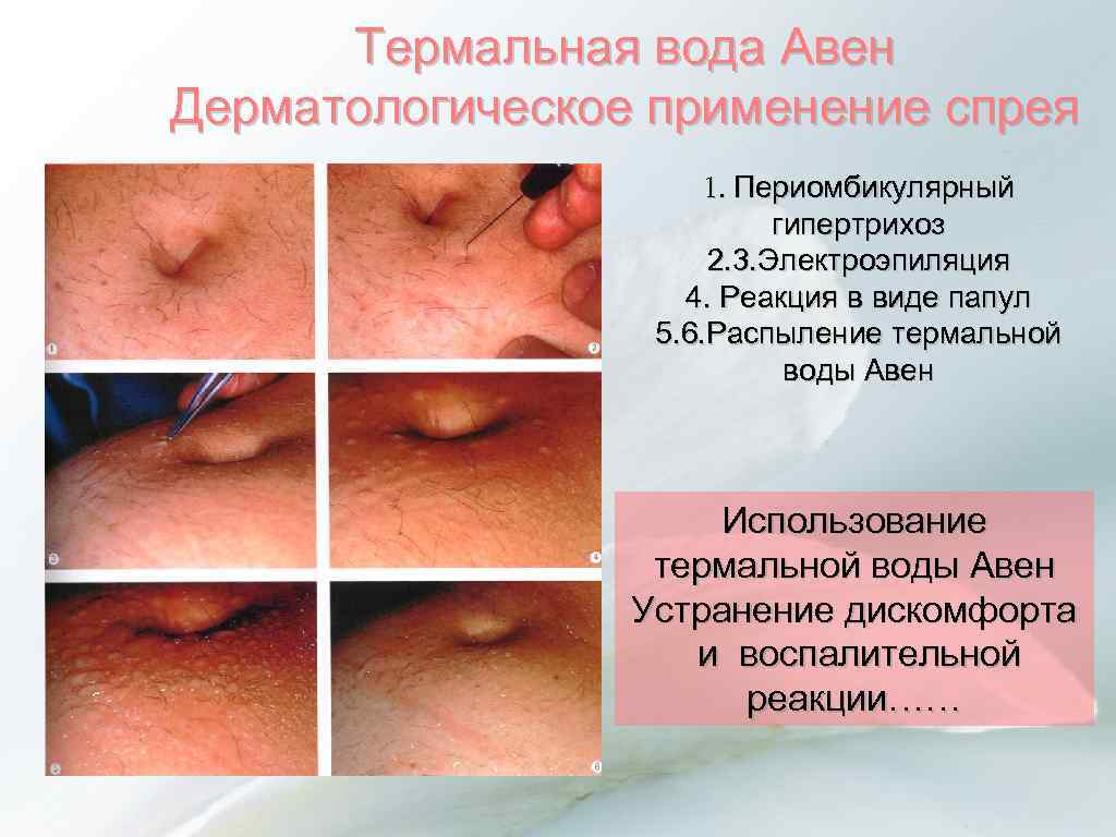 Термальная вода Авен Дерматологическое применение спрея 1. Периомбикулярный гипертрихоз 2. 3. Электроэпиляция 4. Реакция