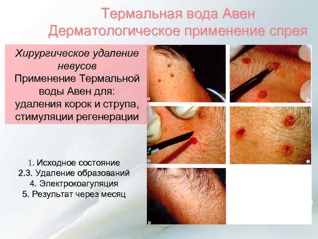 Термальная вода Авен Дерматологическое применение спрея Хирургическое удаление невусов Применение Термальной воды Авен для:
