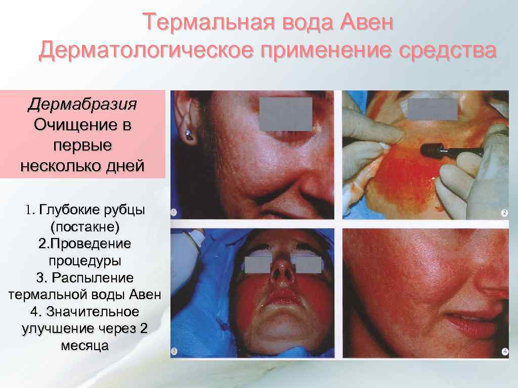 Термальная вода Авен Дерматологическое применение средства Дермабразия Очищение в первые несколько дней 1. Глубокие