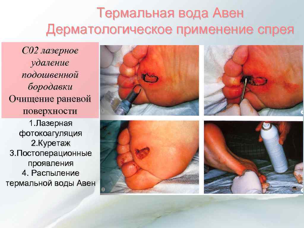 Термальная вода Авен Дерматологическое применение спрея Дерматологическое применение C 02 лазерное удаление подошвенной бородавки