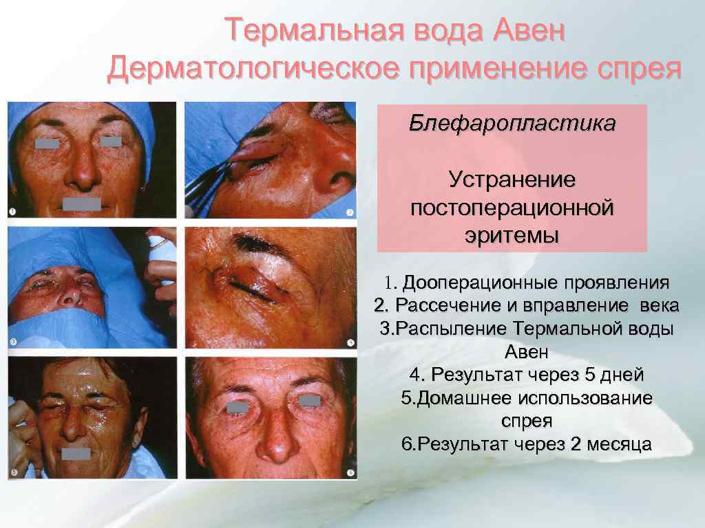 Термальная вода Авен Дерматологическое применение спрея Блефаропластика Устранение постоперационной эритемы 1. Дооперационные проявления 2.