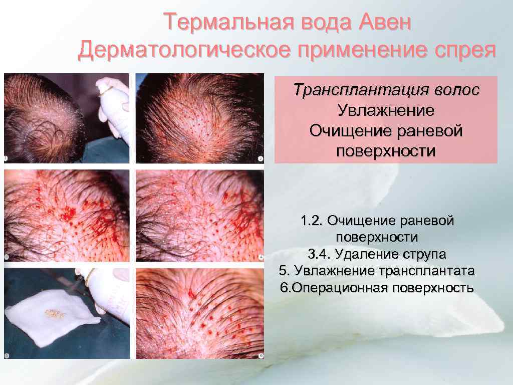 Термальная вода Авен Дерматологическое применение спрея Трансплантация волос Увлажнение Очищение раневой поверхности 1. 2.