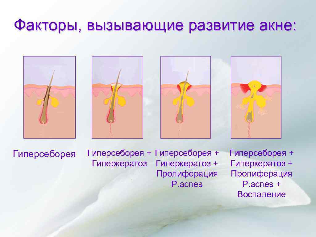 Факторы, вызывающие развитие акне: Гиперсеборея + Гиперкератоз + Пролиферация P. acnes + Воспаление 