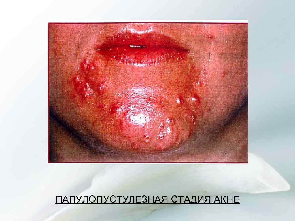 ПАПУЛОПУСТУЛЕЗНАЯ СТАДИЯ АКНЕ 