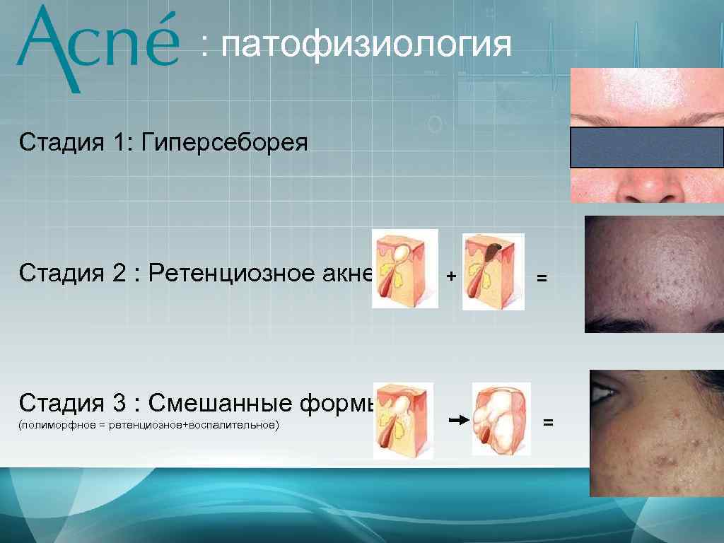 : патофизиология Стадия 1: Гиперсеборея Стадия 2 : Ретенциозное акне Стадия 3 : Смешанные