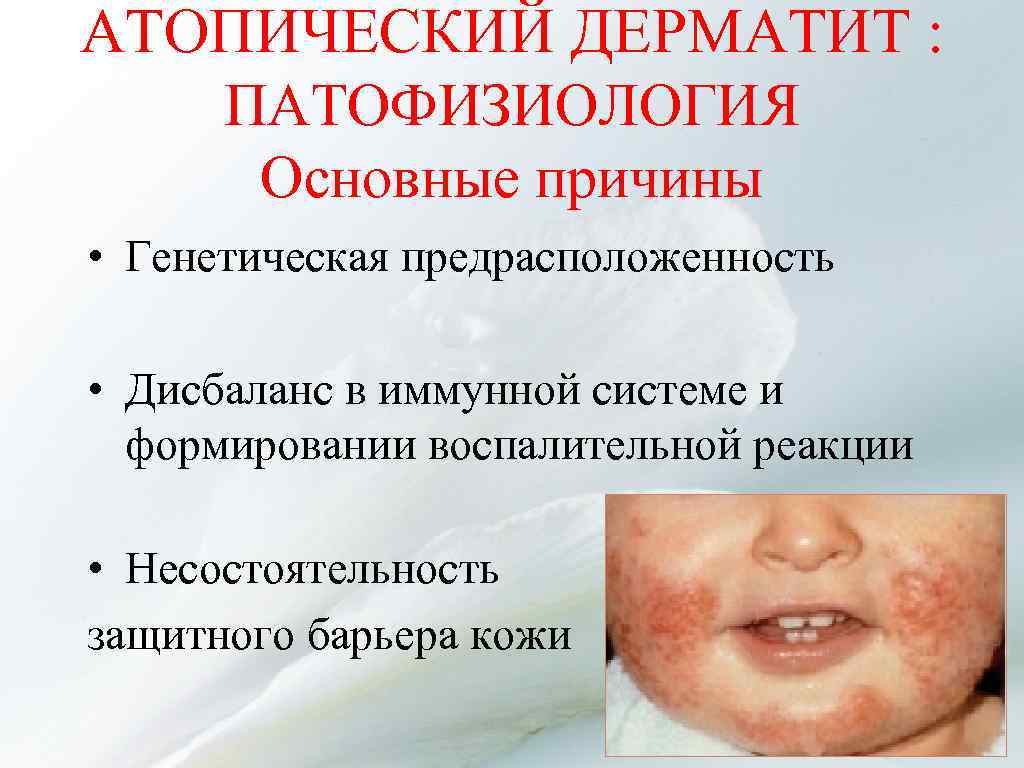 АТОПИЧЕСКИЙ ДЕРМАТИТ : ПАТОФИЗИОЛОГИЯ Основные причины • Генетическая предрасположенность • Дисбаланс в иммунной системе