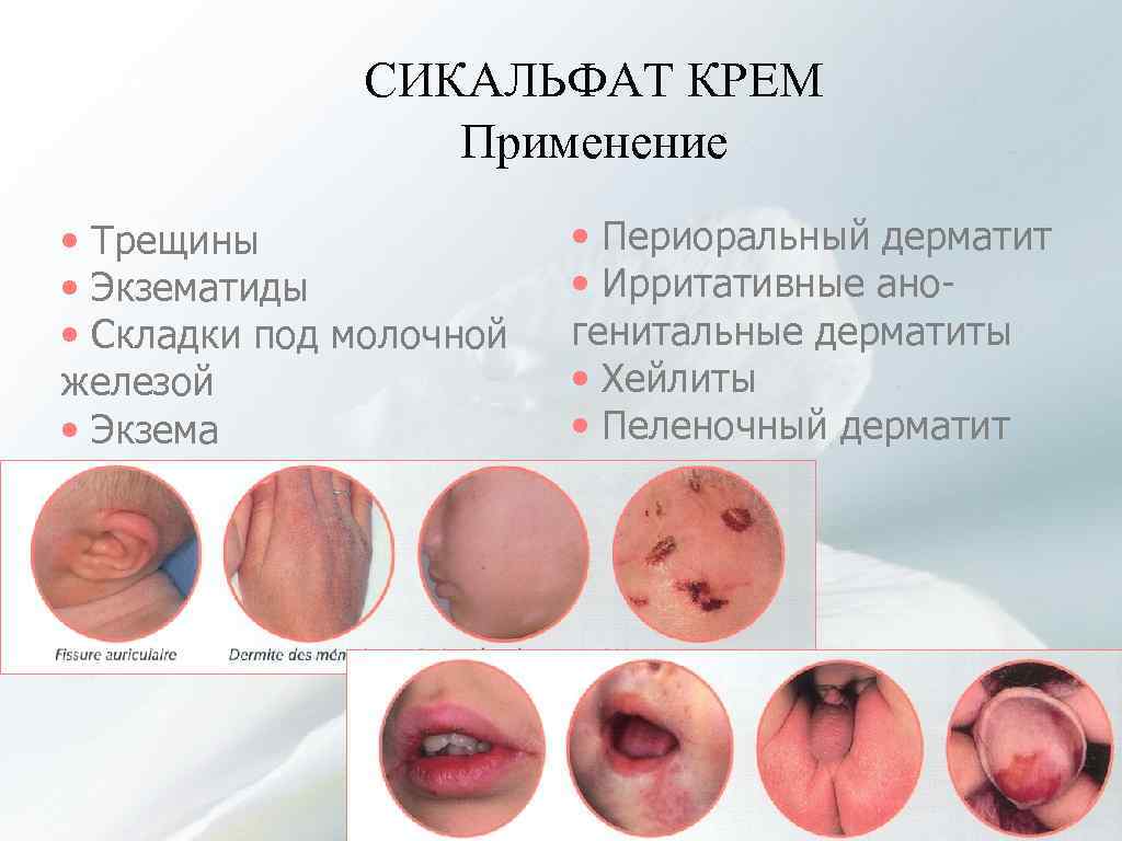 СИКАЛЬФАТ КРЕМ Применение • Трещины • Экзематиды • Складки под молочной железой • Экзема