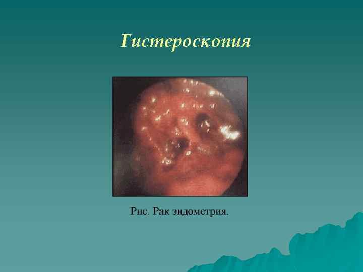 Гистероскопия 