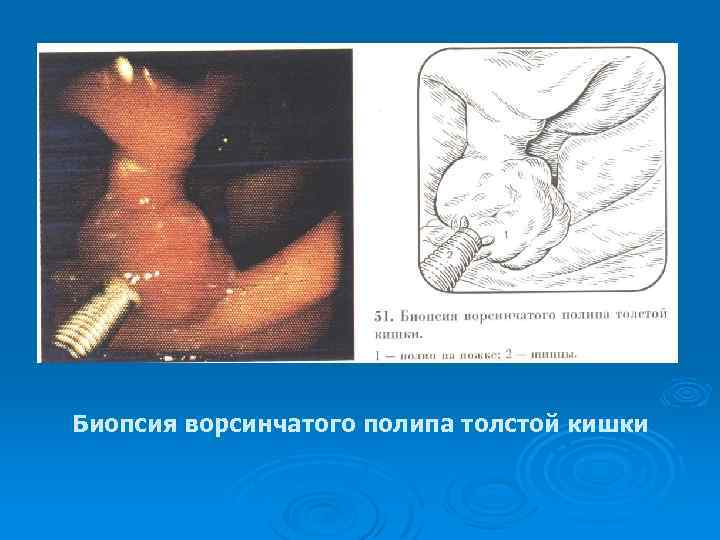 Биопсия ворсинчатого полипа толстой кишки 