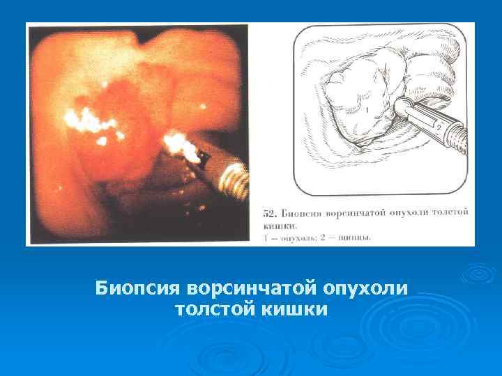 Биопсия ворсинчатой опухоли толстой кишки 