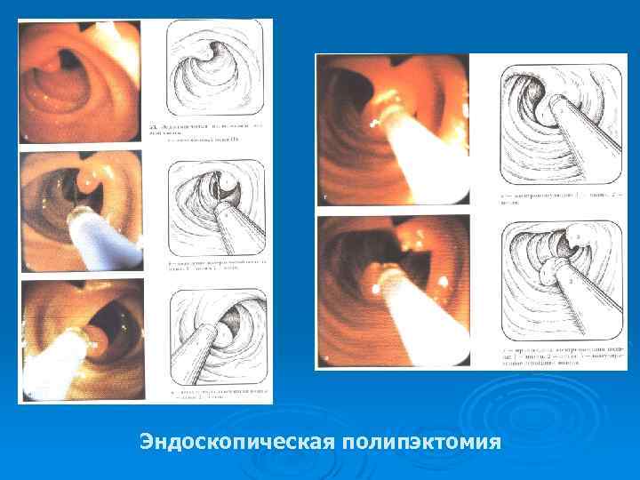 Эндоскопическая полипэктомия 