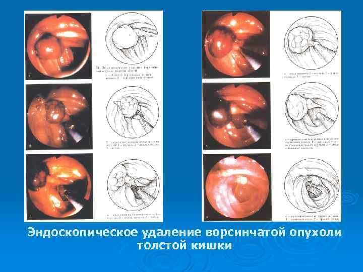 Эндоскопическое удаление ворсинчатой опухоли толстой кишки 