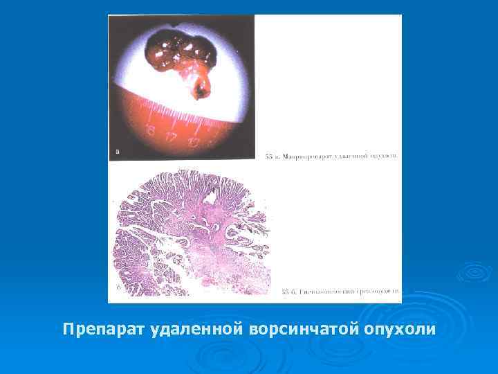 Препарат удаленной ворсинчатой опухоли 