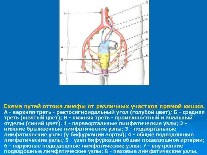 Схема путей оттока лимфы от различных участков прямой кишки. А - верхняя треть -
