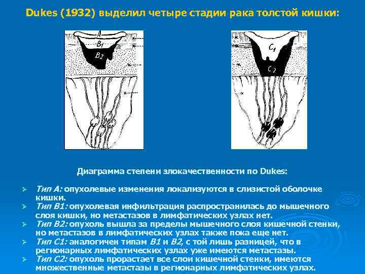Dukes (1932) выделил четыре стадии рака толстой кишки: Диаграмма степени злокачественности по Dukes: Ø