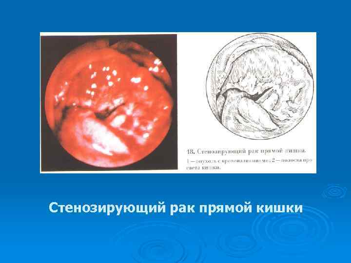 Стенозирующий рак прямой кишки 
