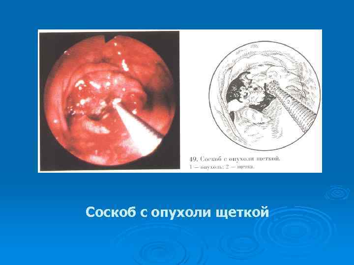 Соскоб с опухоли щеткой 